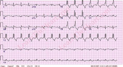 bundle branch block ecg