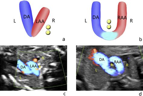 Strategies For Accurate Diagnosis Of Fetal Aortic Arch Anomalies