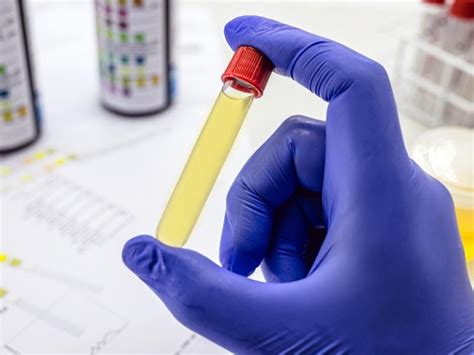 Quanto Tempo A Urina Pode Ficar Na Geladeira Para Exame