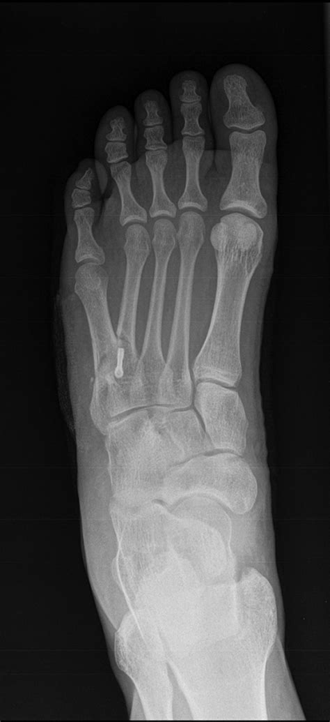 Dorsoplantar Postoperative Radiograph Download Scientific Diagram