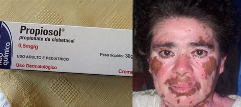 Propionato De Clobetasol Antes E Depois - propionato de clobetasol no tratamento de vitiligo - universo feminino ...