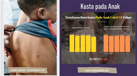 Hapus Stigma Kusta Yang Menyesatkan Kusta Bukan Kutukan Dan Bisa