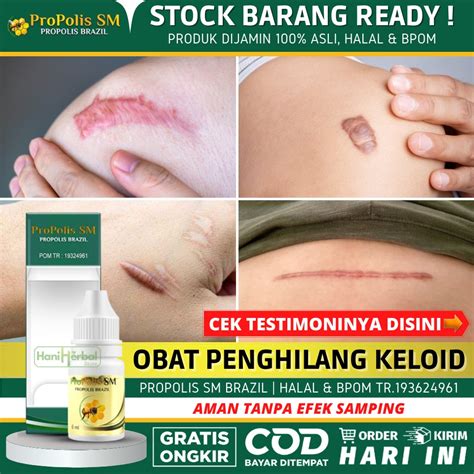 Jual Obat Keloid Oles Salep Keloid Penghilang Keloid Bekas Caesar