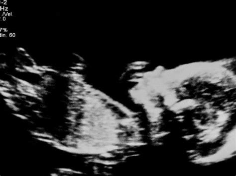 Vagina estrecha podría ser señal de un parto doloroso Salud180