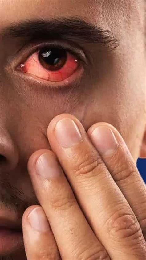 अचानक बढ़ गया है Eye Flu का खतरा घर से बाहर निकलते समय फॉलो करें ये टिप्स