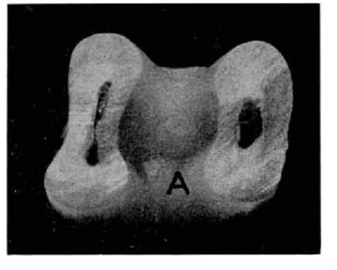 The Intermediate Bifurcational Ridge A Study Of The Morphology Of The