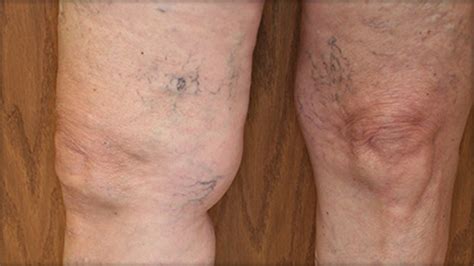 Varicose Veins Spider Or Reticular Veins Peripheral Vascular Disease