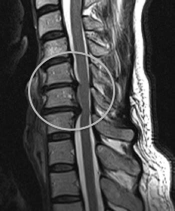 Bandscheibenvorfall HWS Therapie OP