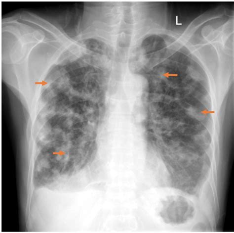 Septic Pulmonary Embolism Bmj Case Reports