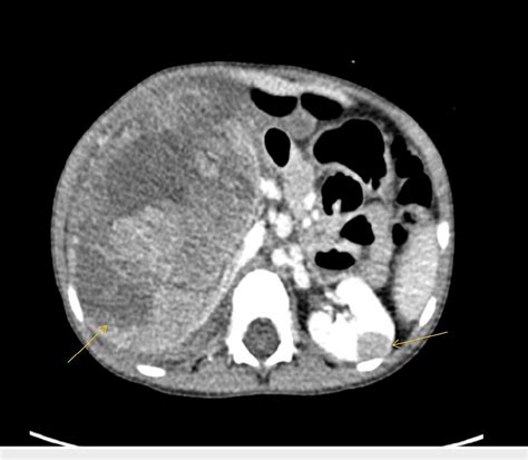 Figure 1 From Bilateral Wilms Tumor With Different Responses To