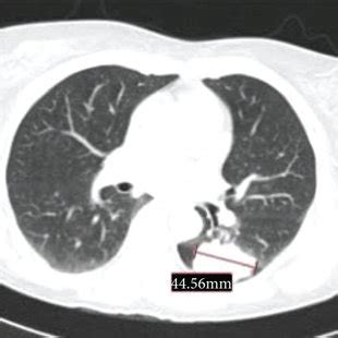 Lung mass on thoracic CT scan at diagnosis. | Download Scientific Diagram