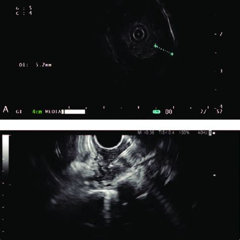 Endoscopic Ultrasound Eus Revealing The Esophageal Wall Was Thickened