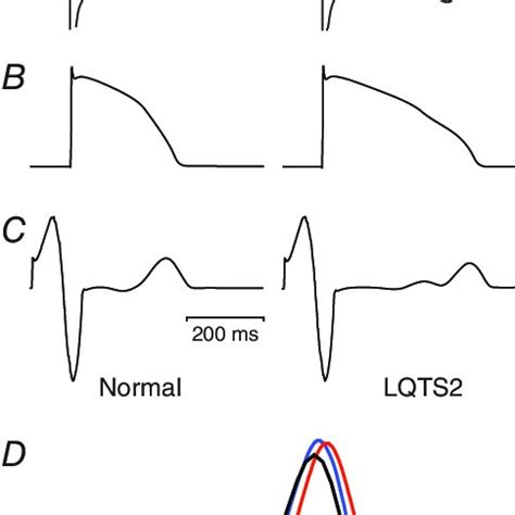 Whole Heart Simulations Of LQTS Type 2 Based On The O Hara Rudy Human