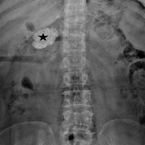 Milk Of Calcium Cyst Ultrasound