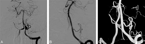 Figure 1 From Clinical And Angiographic Follow Up Of Stent Only Therapy