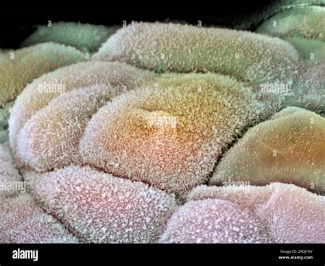 Ovarian Cancer Coloured Scanning Electron Micrograph Sem Of Cancer Cells In The Human Ovary