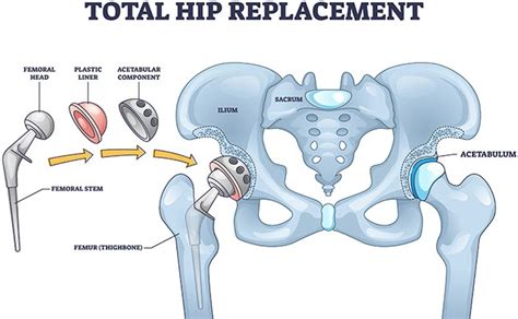 Hip Replacements Surgery Tips For Before And After Surgery