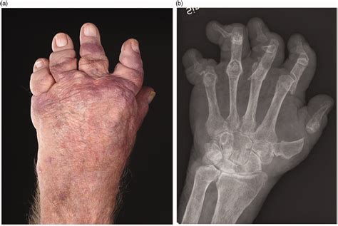 Radiographic Scoring Systems For Psoriatic Arthritis Are Insufficient