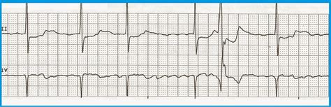 Float Nurse Practice Ekg Rhythm Strips 213