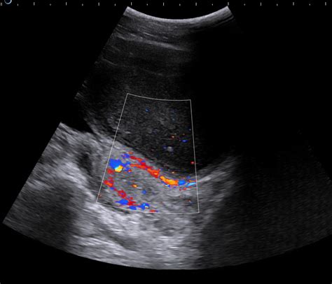 Pelvic Congestion Ultrasound