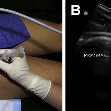 Pdf Ultrasound Guided Intra Articular Injection Of The Hip The Nashville Sound