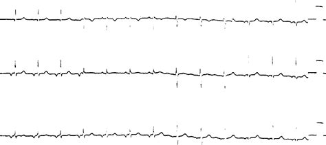 Figure 3 from The P-wave morphology : what does it tell us ? | Semantic ...