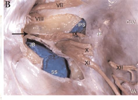 Figure 2 From The Microsurgical Anatomy Of The Glossopharyngeal Nerve