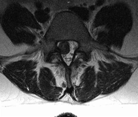 Herniated Disc Mri L5
