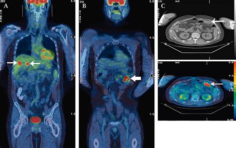 F Fdg Pet Ct Imaging Of Colorectal Cancer A Pictorial Review