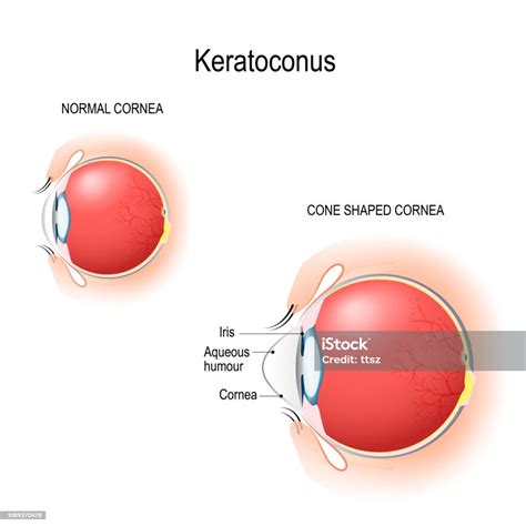 원추 각 막입니다 정상적인 각 막 그리고 원뿔 모양의 각 막입니다 눈 신체 부분에 대한 스톡 벡터 아트 및 기타 이미지 눈