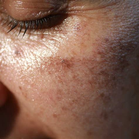 Solar Keratoses And Brown Spots Devonshire Dermatology