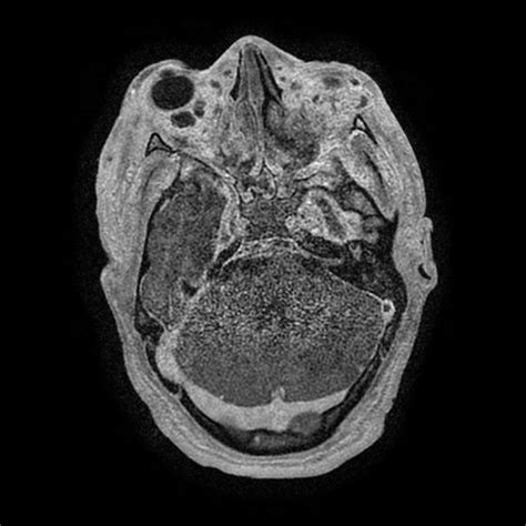 Axial T1 Weighted Magnetic Resonance Imaging With Gadolinium Contrast