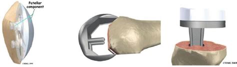 Basic Steps In Tka Patella Femur And Tibia Resurfacing As Shown By