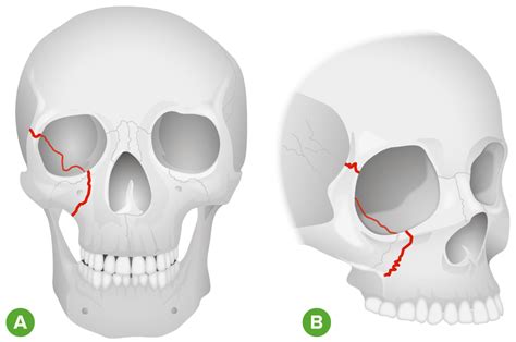 Fracturas Orbitales Concise Medical Knowledge