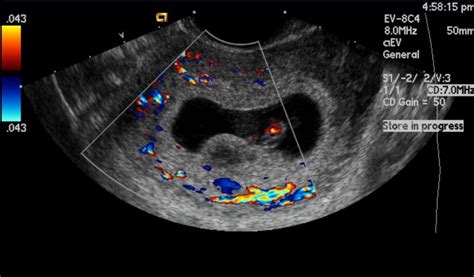 Subchorionic hemorrhage - wikidoc