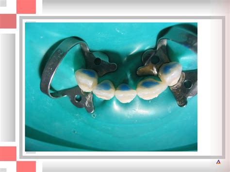 Травмы зубов у детей и их ортопедическое лечение - online presentation