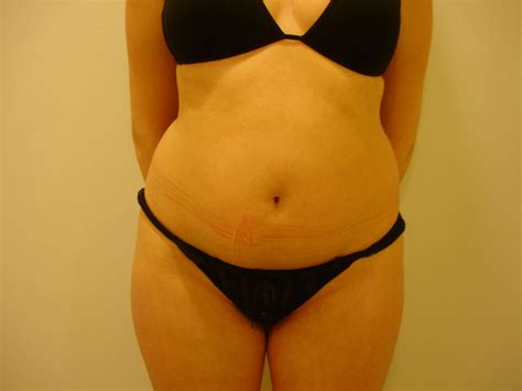 Liposuzione Liposcultura Chirurgia Estetica Pisa Dott Cecchini