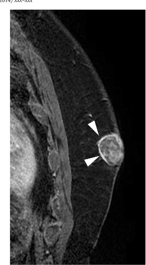 Figure 3 From Pilomatricoma Of The Male Breast Sonographic