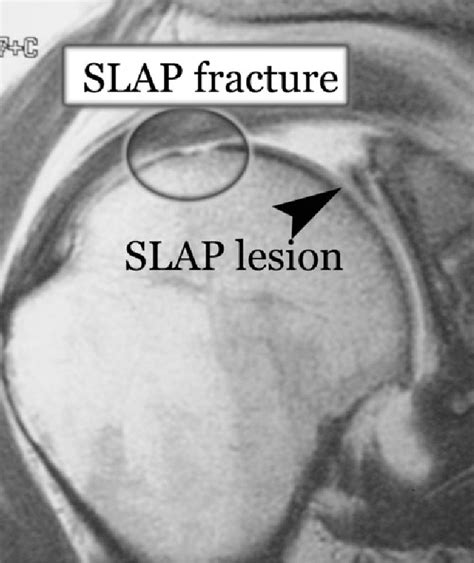 Figure From The Diagnosis And Treatment Of Superior Labrum Anterior