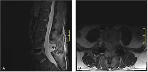 dural scarring  repair issues clinical tree