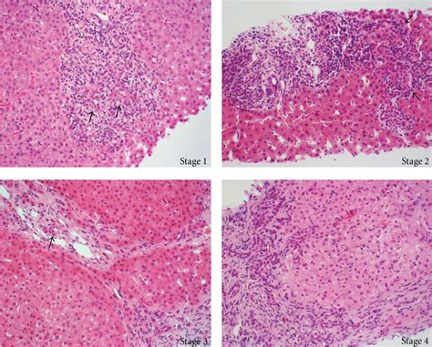 Pdf Sex Differences Associated With Primary Biliary Cirrhosis