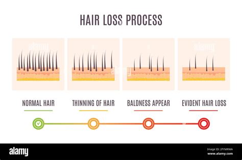 Hair loss stages, illustration Stock Photo - Alamy