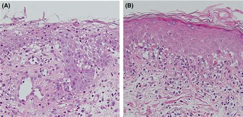 Histopathological Examination Showing Skin Biopsy Specimens From A