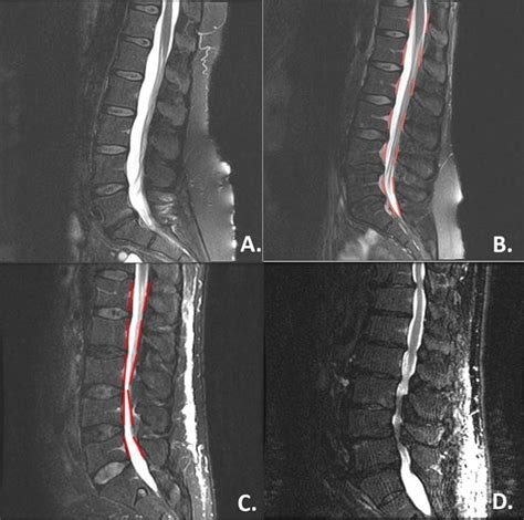 MRI classification system for lumbar spinal stenosis. a Type I normal ...