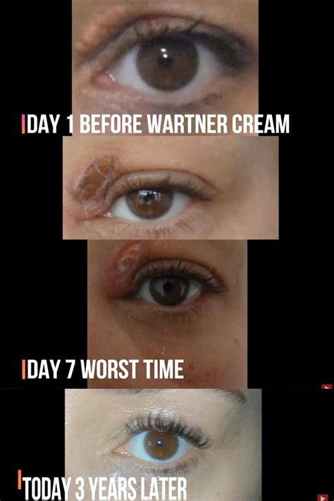Xanthelasma Wartner Pen Remove Xanthelasma At Home Fatty Eye Deposit