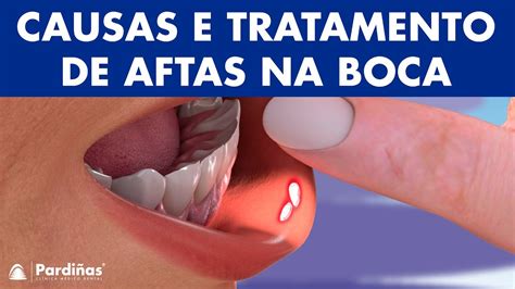 Muitas Aftas Na Boca O Que Pode Ser - AFTA NA BOCA - Causas e tratamento de aftas © - YouTube