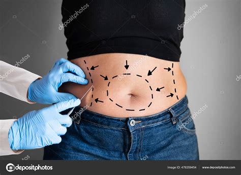 Abdominoplasty Obesity Surgery Aesthetic Abdominal Fat Liposuction