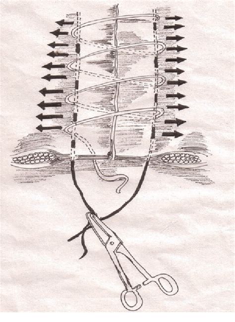 Figure 4 From Reinforced Tension Line Suture Closure After Midline