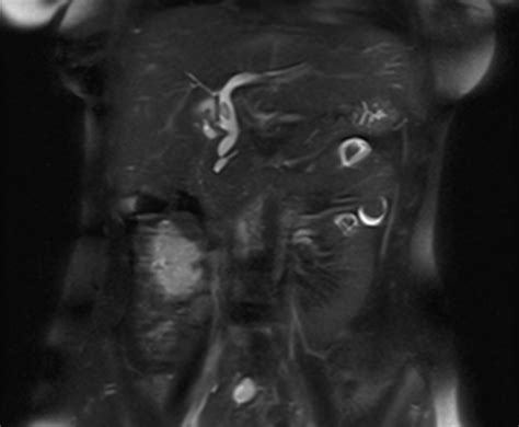 Choledochal Cyst Type Ic Mrcp Image Radiopaedia Org