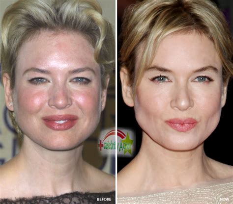 Do celebrities get acne? - Celebrity acne scars - Celebrities with Acne | Celebrities with acne ...